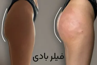 فیلر بادی (Body Filler)